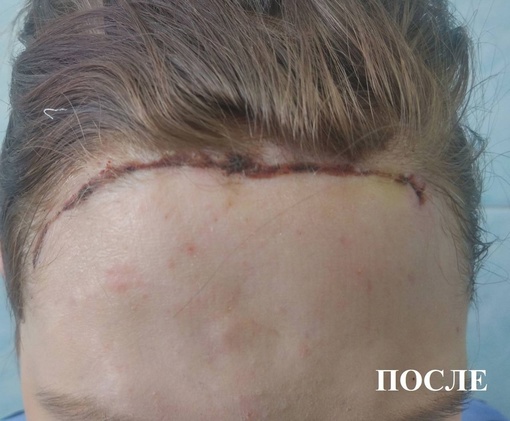 😨 С «дырой во лбу». В Башкирии врачи установили 18-летней пациентке титановую пластину в череп 
 
18-летняя..