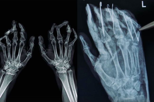 В Новосибирске врачи вернули здоровые пальцы жертве обморожения

В 2010 году жительница Сахалина Елена попала..