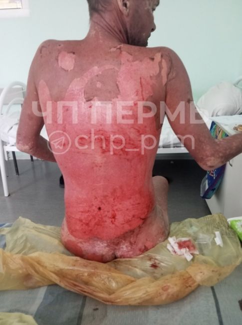 Житель Пермского края утверждает, что из-за врачебной ошибки у него в течение двух недель слезла кожа...