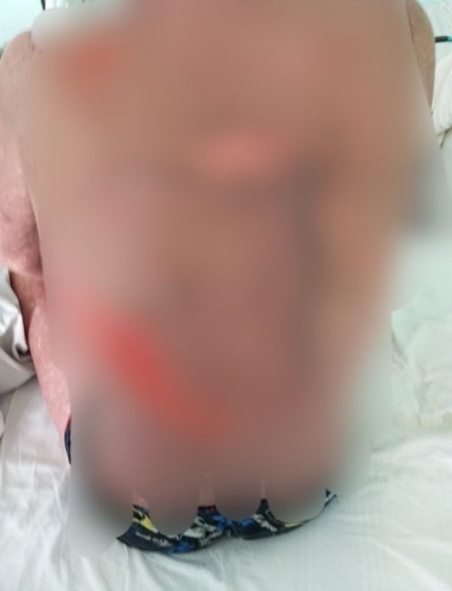 ‼️У мужчины, который находится в больнице в Перми, неожиданно слезла кожа после принятия медикаментов...