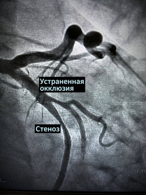 Арзамасские медики спасли от инфаркта 48-летнего жителя Перевоза. Мужчина проснулся с болями за грудиной,..