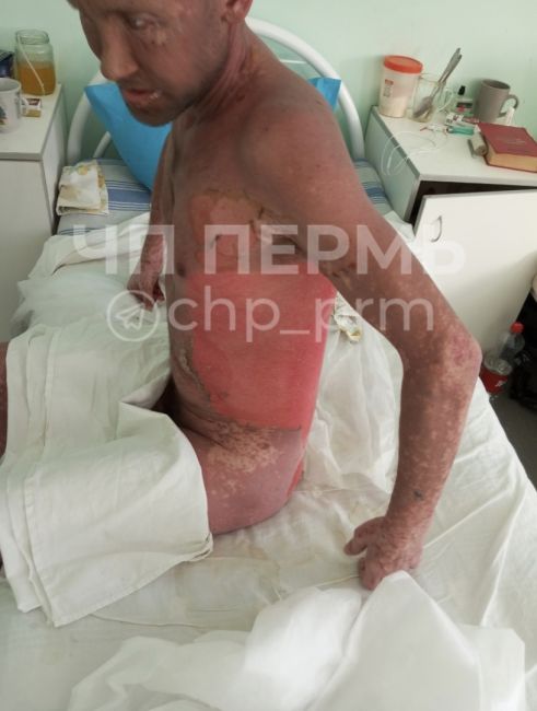 Житель Пермского края утверждает, что из-за врачебной ошибки у него в течение двух недель слезла кожа...