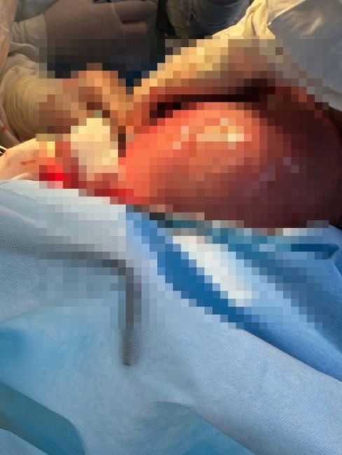 🔞В Башкирии врачи удалили женщине 3-килограммовую опухоль 
 
Сегодня врачи Учалинской центральной..