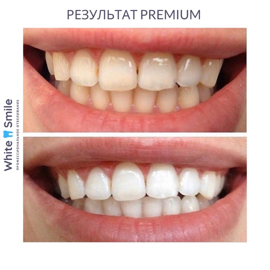 ❕Ищем моделей❕
В студию косметического осветления зубов [club203042740|WHITE SMILE]

🔹LIGHT осветление на 4-6 тонов
1.170₽..